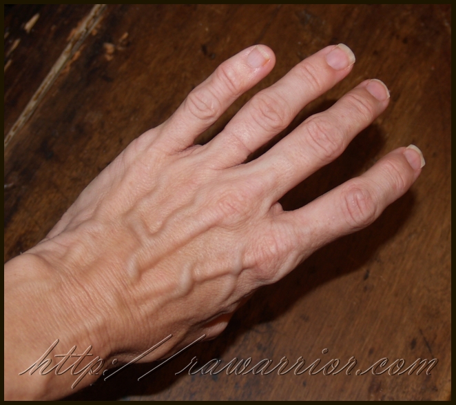 Rheumatoid Arthritis: hands are significant