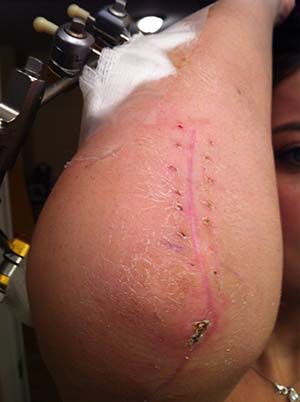 surgery Rheumatoid Disease elbow