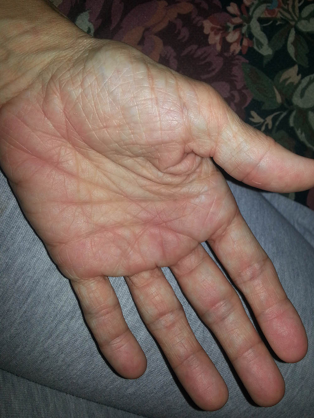 red swollen hand