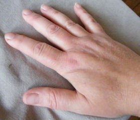 RA swollen fingers